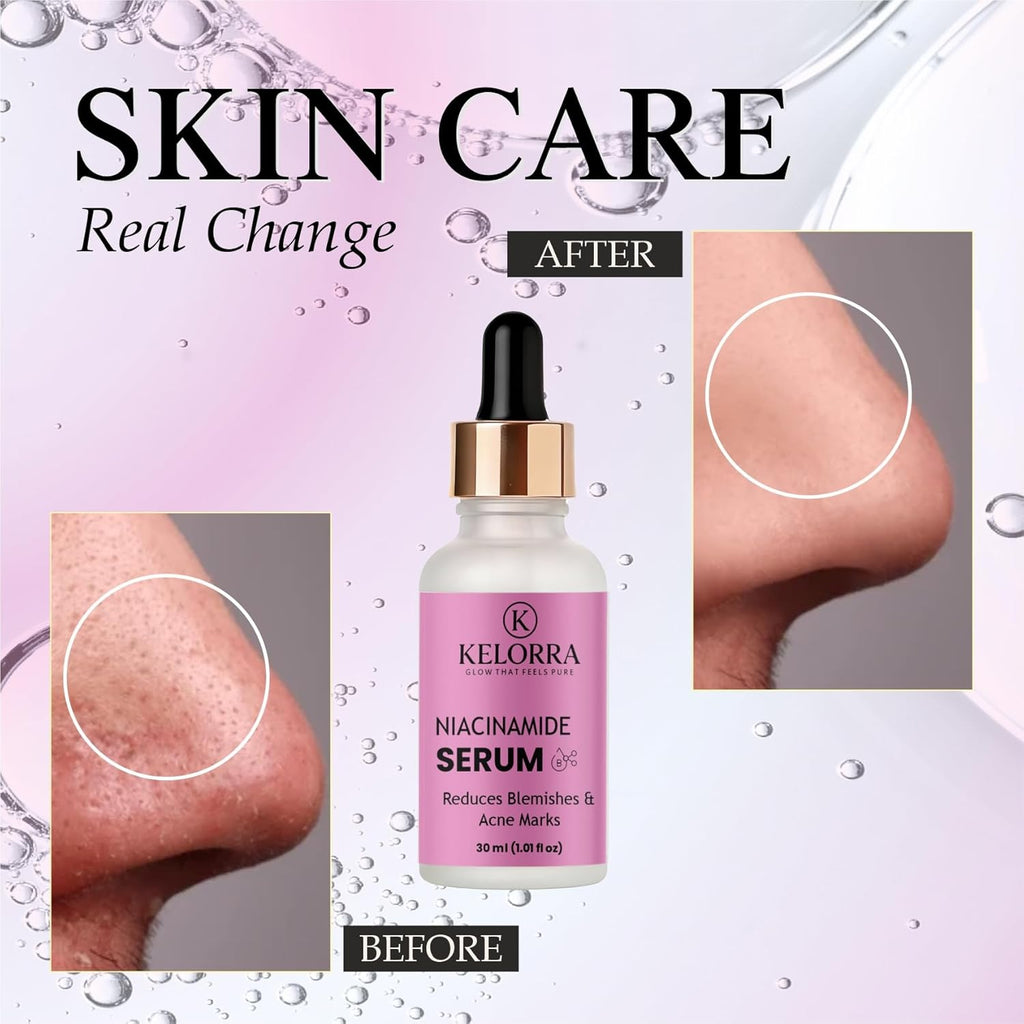 KELORRA Niacinamide Serum, Reduces Blemishes & Acne Marks, 30ml (1.01 fl oz)