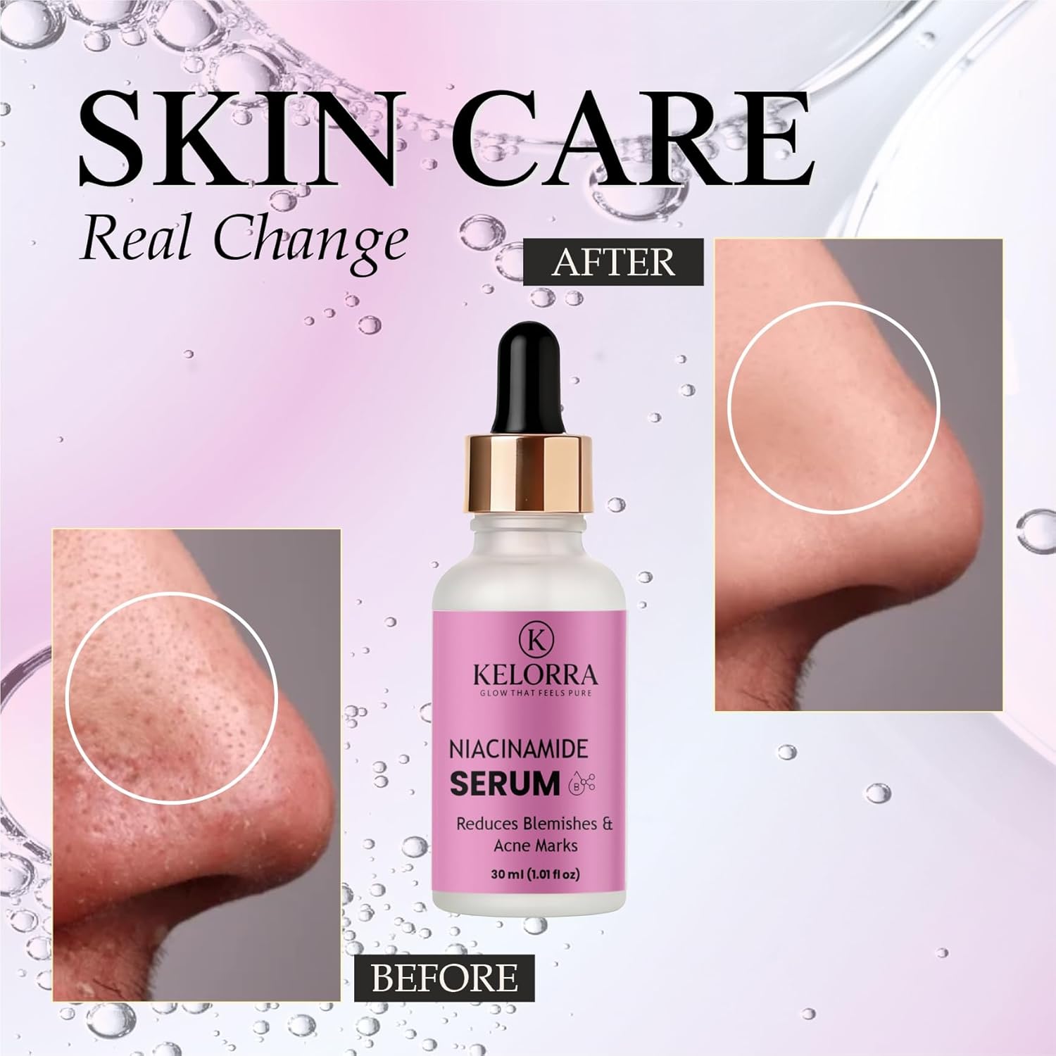 KELORRA Niacinamide Serum, Reduces Blemishes & Acne Marks, 30ml (1.01 fl oz)