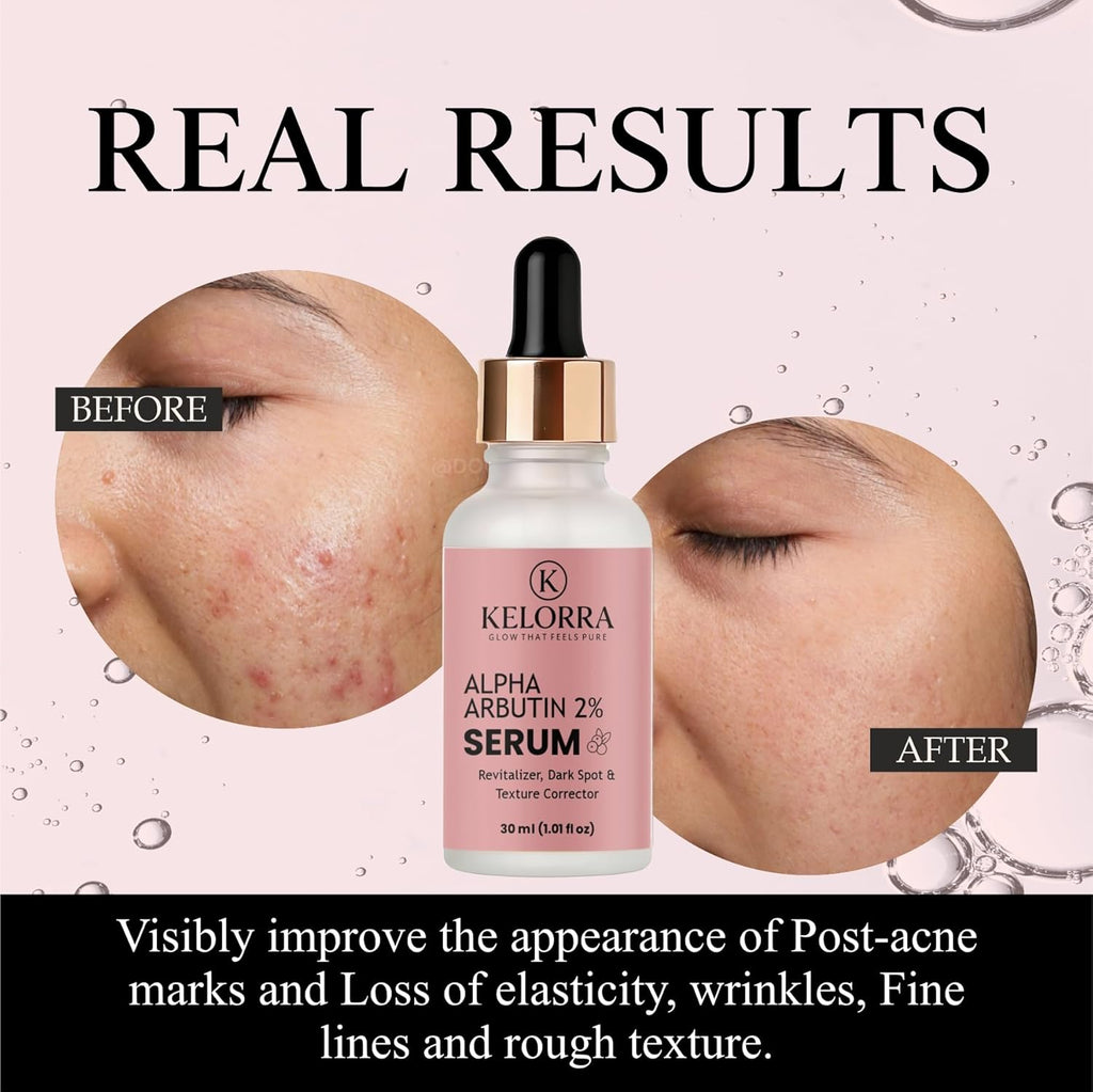 KELORRA Alpha Arbutin 2% Serum, Revitalizer, Dark Spot & Texture Corrector, 30ml