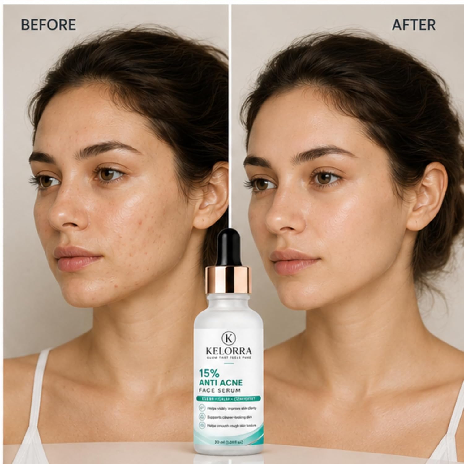 Kelorra 15% Anti Acne Face Serum | Lightweight Daily Skincare Serum | Clear & Calm Facial Care Formula | Suitable for Oily & Acne-Prone Skin | Dropper Bottle | 30 ml