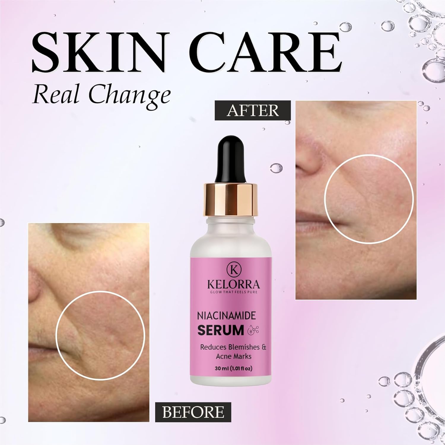 KELORRA Niacinamide Serum, Reduces Blemishes & Acne Marks, 30ml (1.01 fl oz)